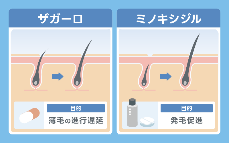 プロペシア やめてよかった AGA治療薬