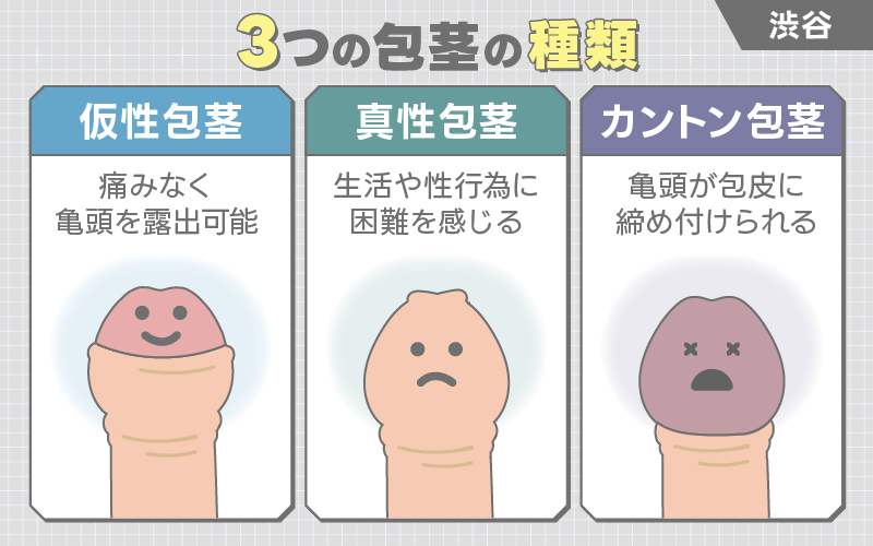 渋谷 包茎の種類
