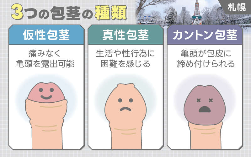 札幌 包茎 種類