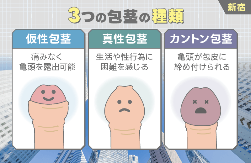 新宿 包茎 種類